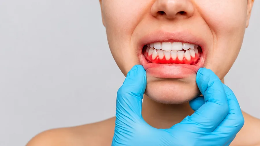 Periodoncia